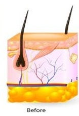 hair removal 3.jpg