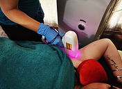laser hair removal
