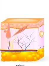 hair removal 3.jpg