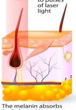 hair removal 3.jpg